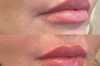 before and after lip filler by Jocelyn Brackett