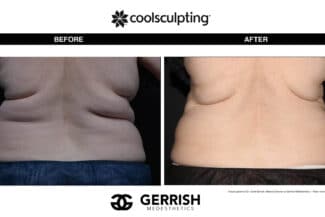CoolSculpting before and after female
