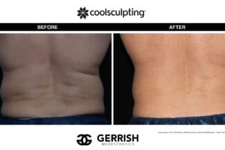 CoolSculpting before and after male back