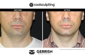 CoolSculpting before and after male jawline