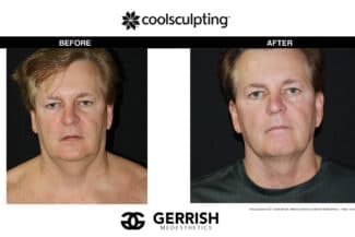 CoolSculpting before and after male face