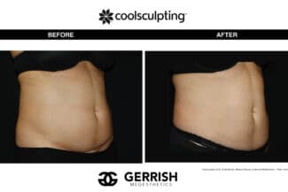 CoolSculpting before and after female stomach