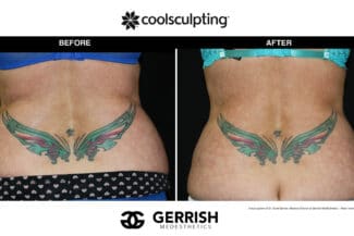 CoolSculpting before and after female hips