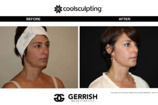CoolSculpting before and after female face