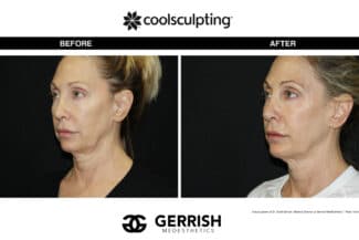 CoolSculpting before and after female face